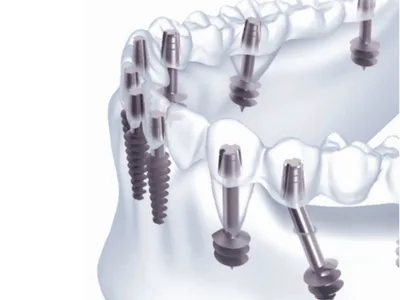 Procédure implant basal
