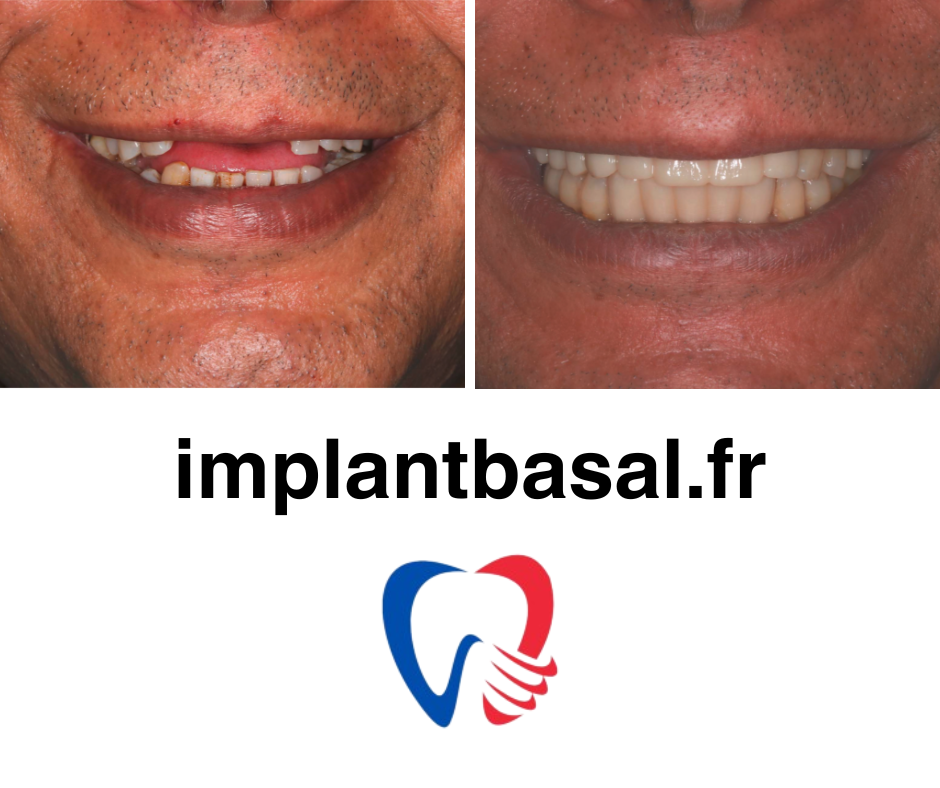 implants basaux