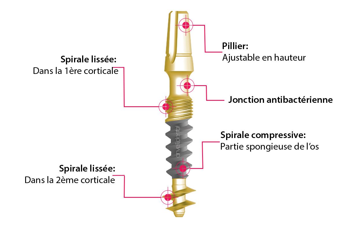 implant-basal