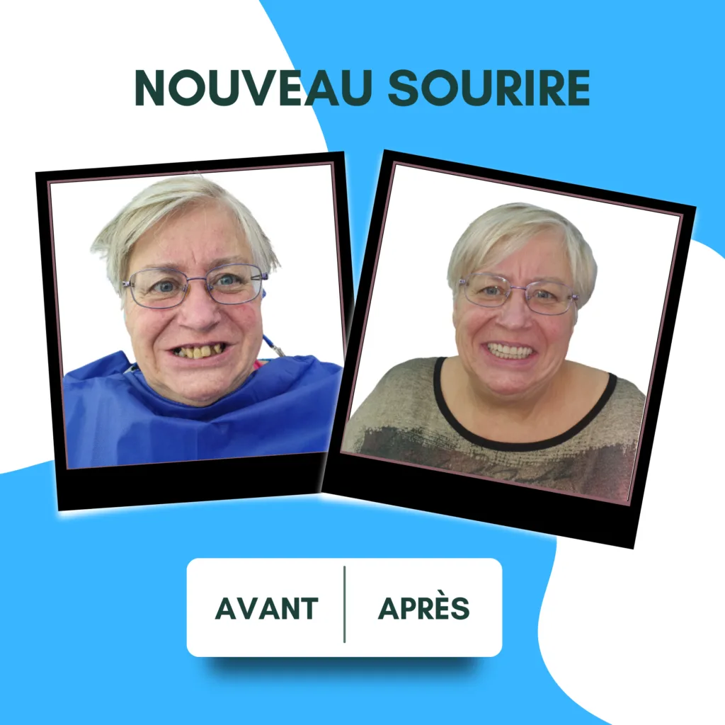 implant basal avant apres