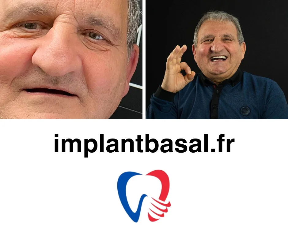 Rejet Implant Dentaire