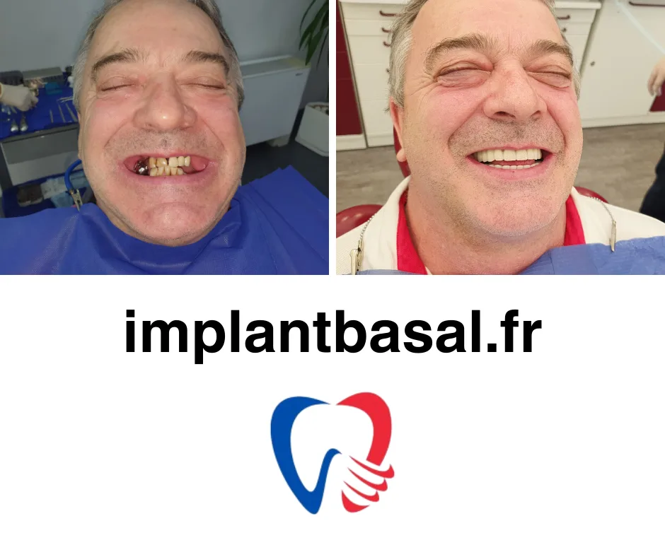 Rejet Implant Dentaire
