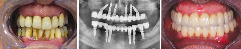 implant dentaire traditionnel