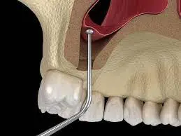 sinus lift