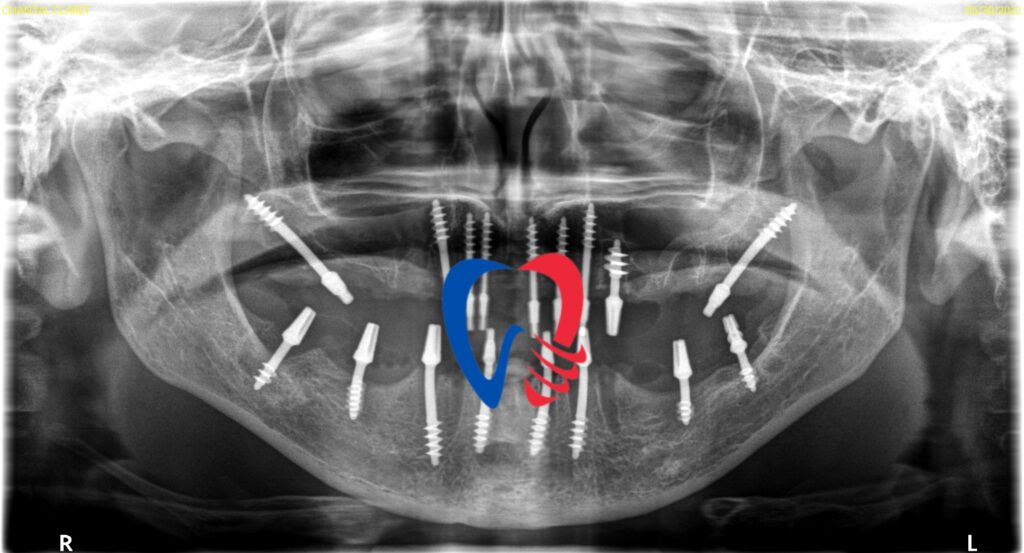 pas assez d'os pour implant dentaire