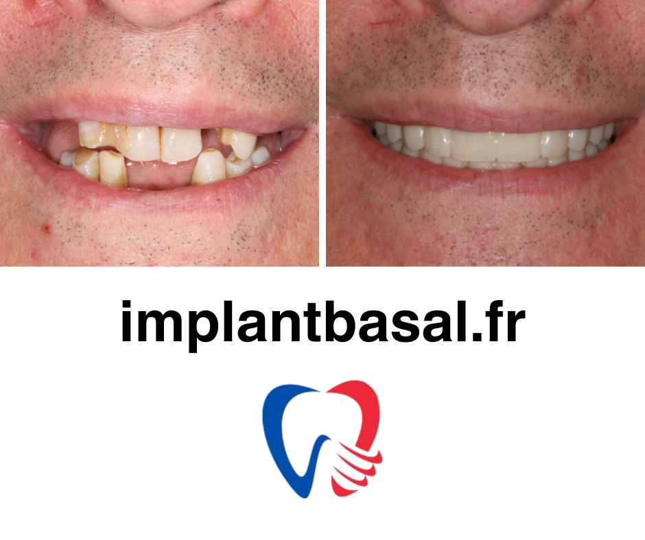 Prix des implants dentaires