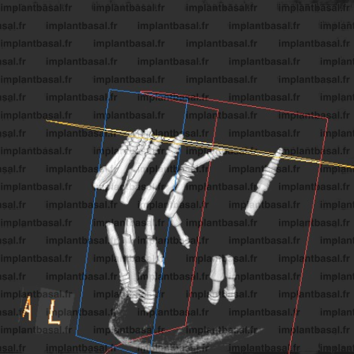 Implant basal après - Isabelle