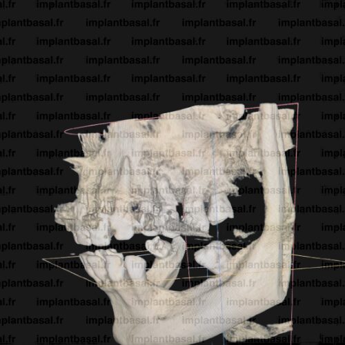 Implant basal avant - Isabelle