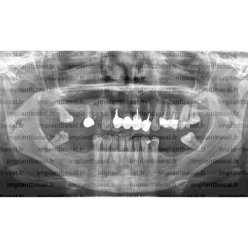 Implant basal avant - Sylvie