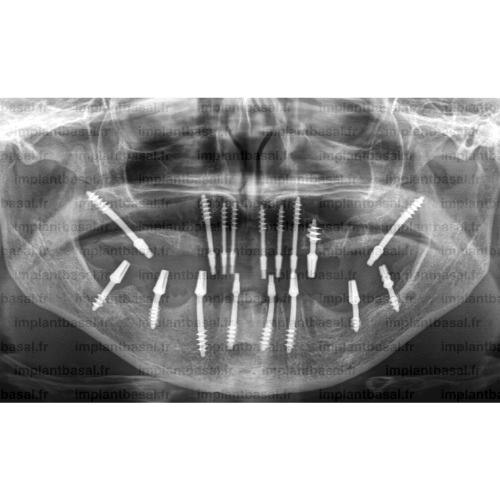 implant basal après - Sylvie