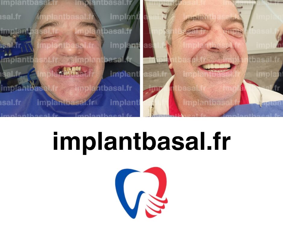 remplacement des dents avec parodontite