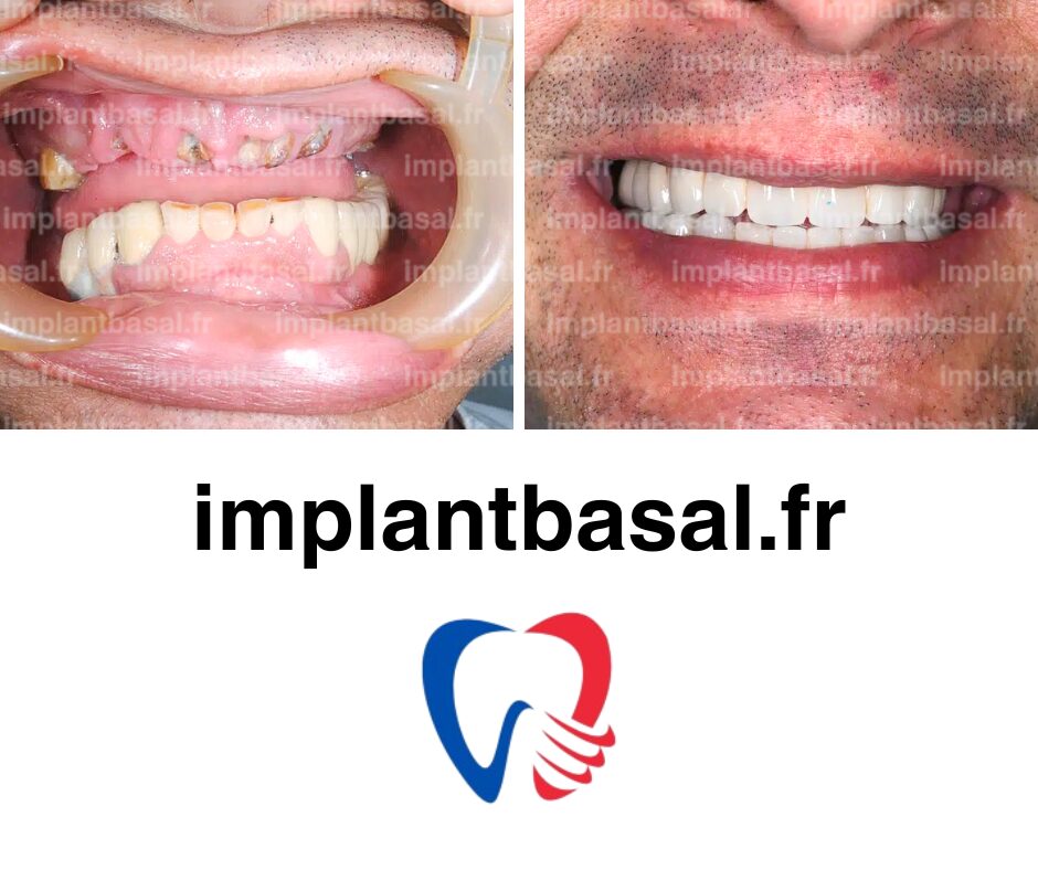 remplacement des dents avec parodontite