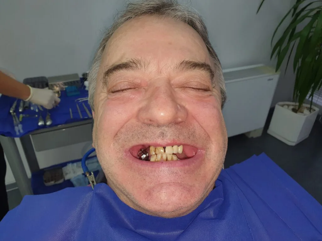 implant basal avant