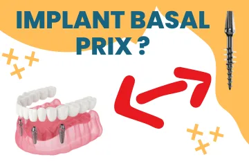 Implant basal prix