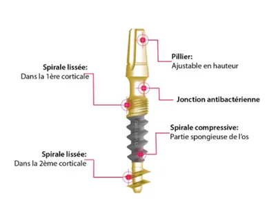 Implant dentaire nouvelle génération
