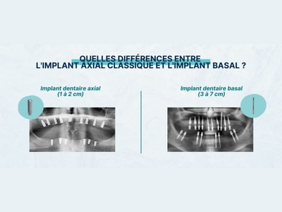 Implant basal vs implant classique