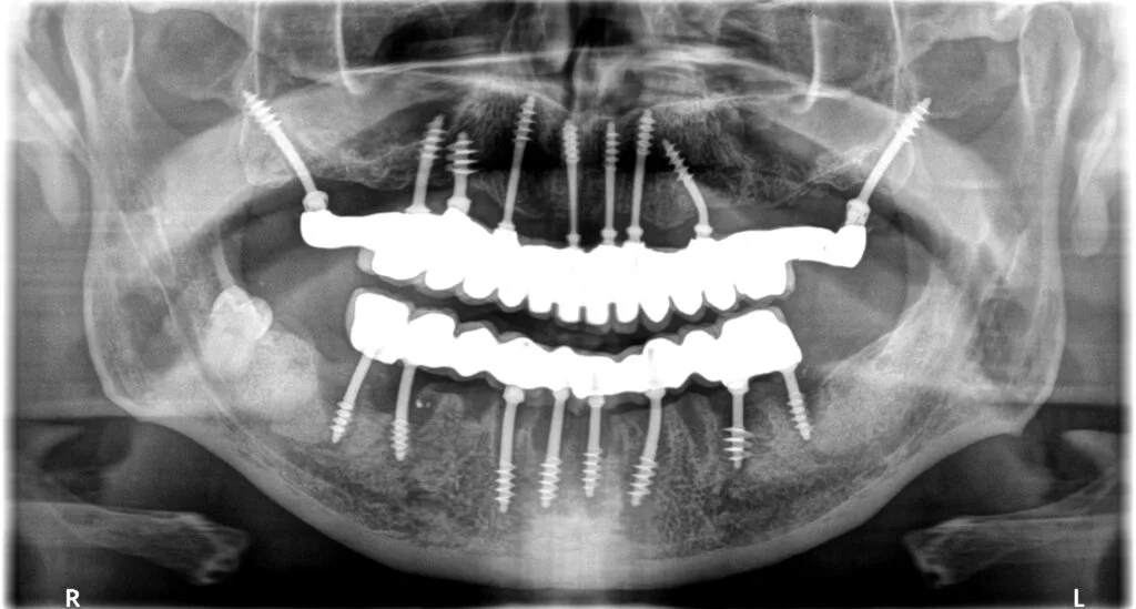 implant basal