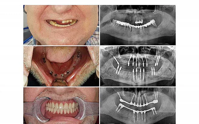 Technique Implant Basal