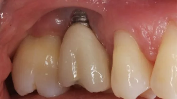Rejet Implant Dentaire
