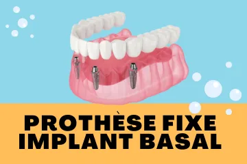 prothèse fixe Implant basal