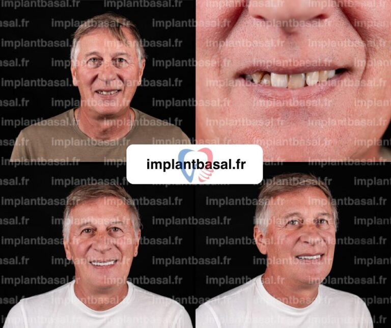 Implant basal