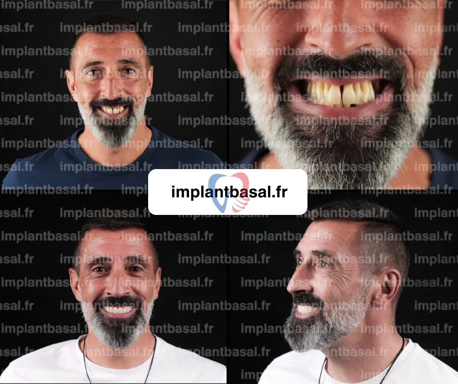 Implant basal