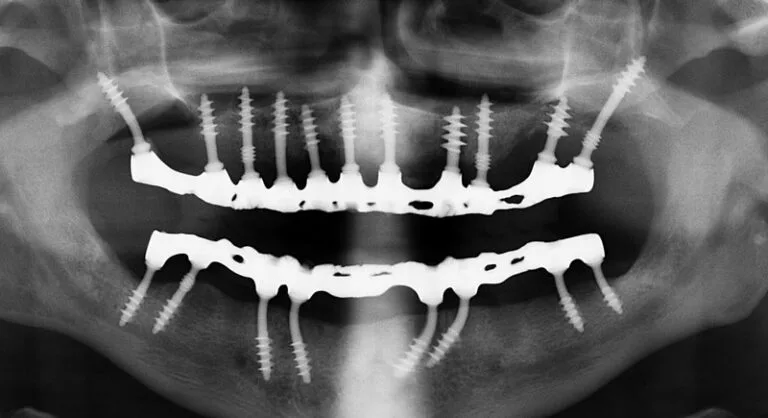 Implant dentaire nouvelle génération