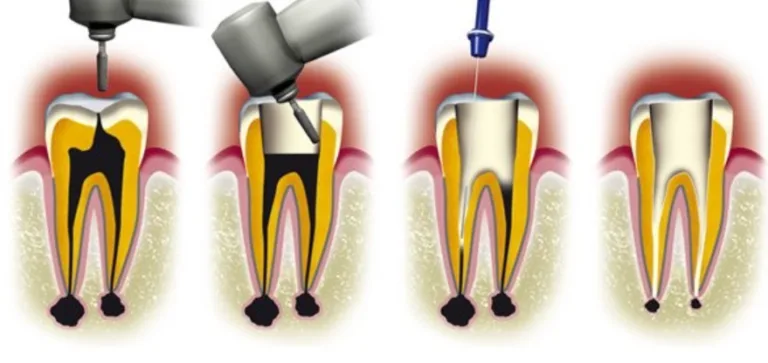 dévitalisation dent