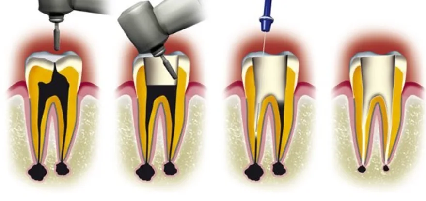 dévitalisation dent
