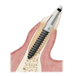 implant-dentaire-basal