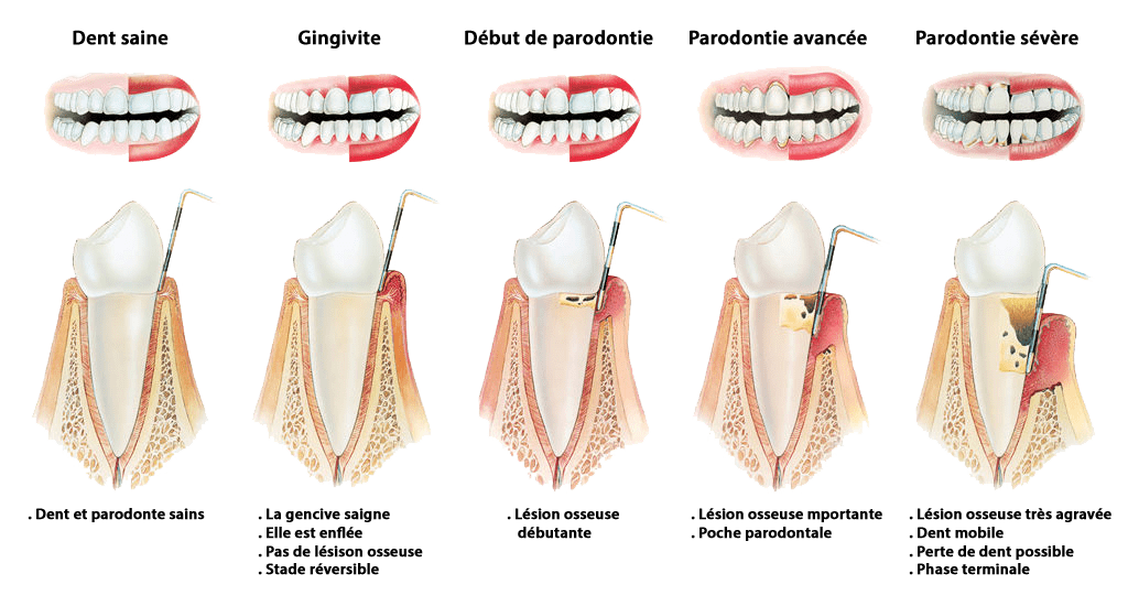 stades parodontite