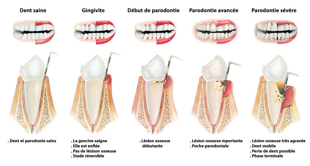 stades parodontite