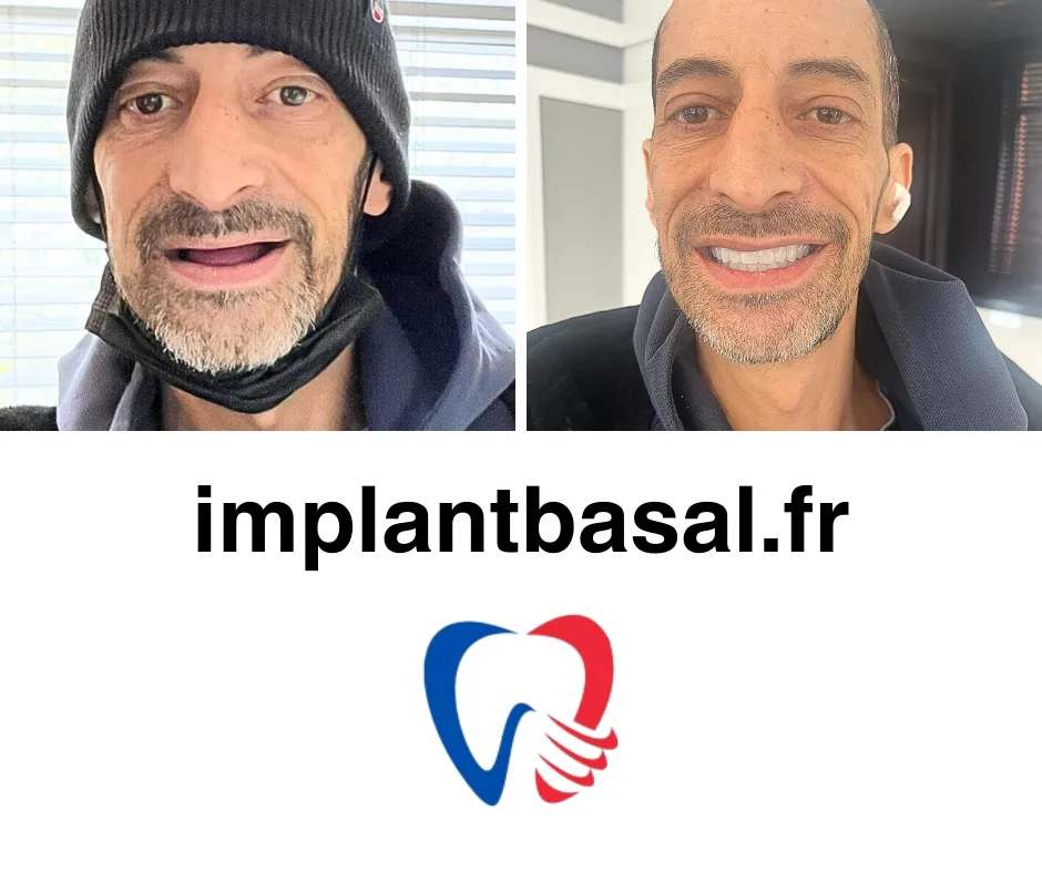 implants immédiats