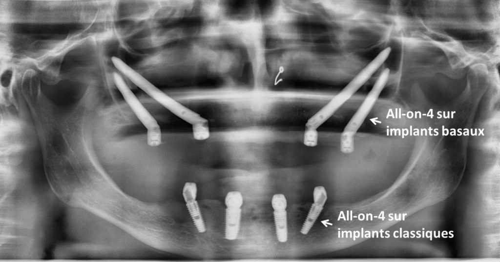 Implant zygomatique