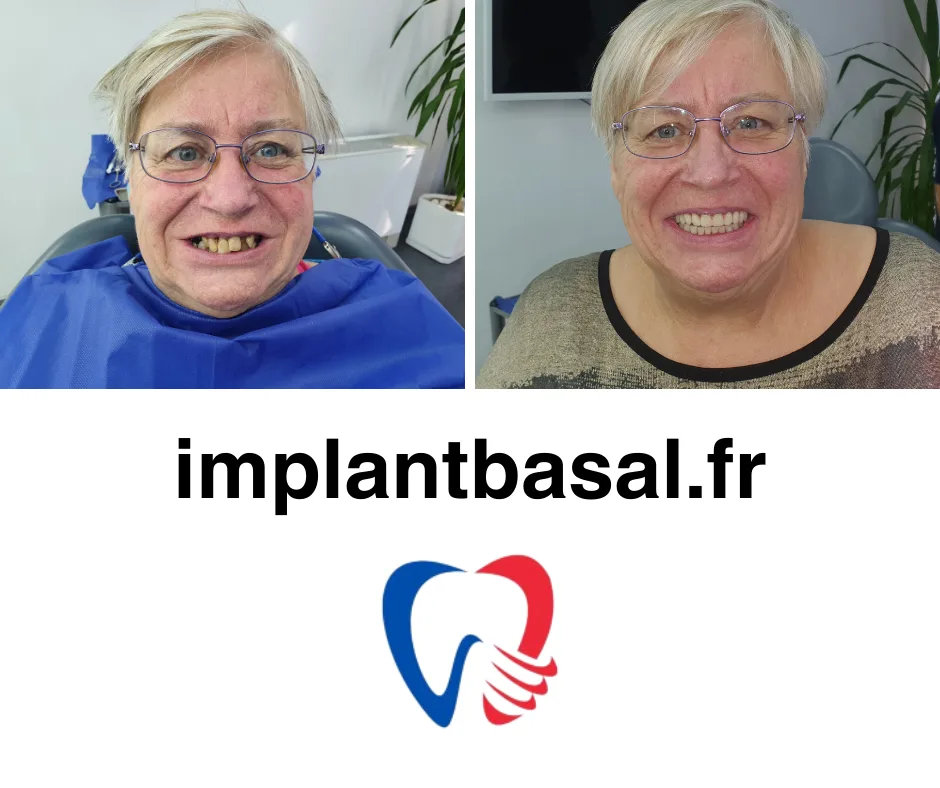 Implant basal prix