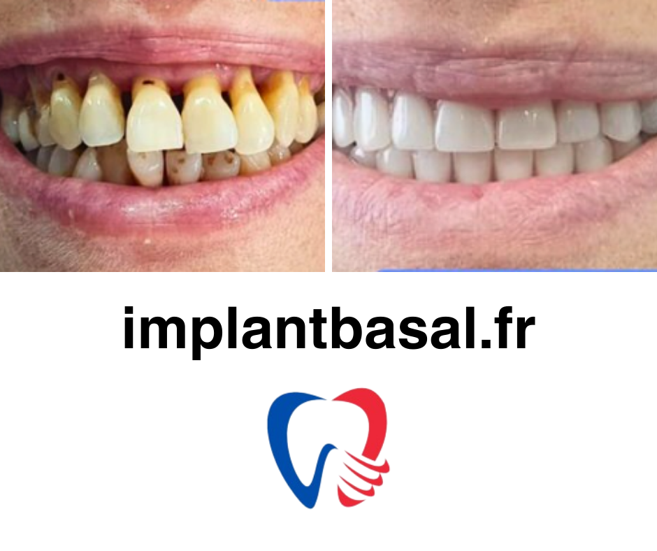 implant basal photo 11