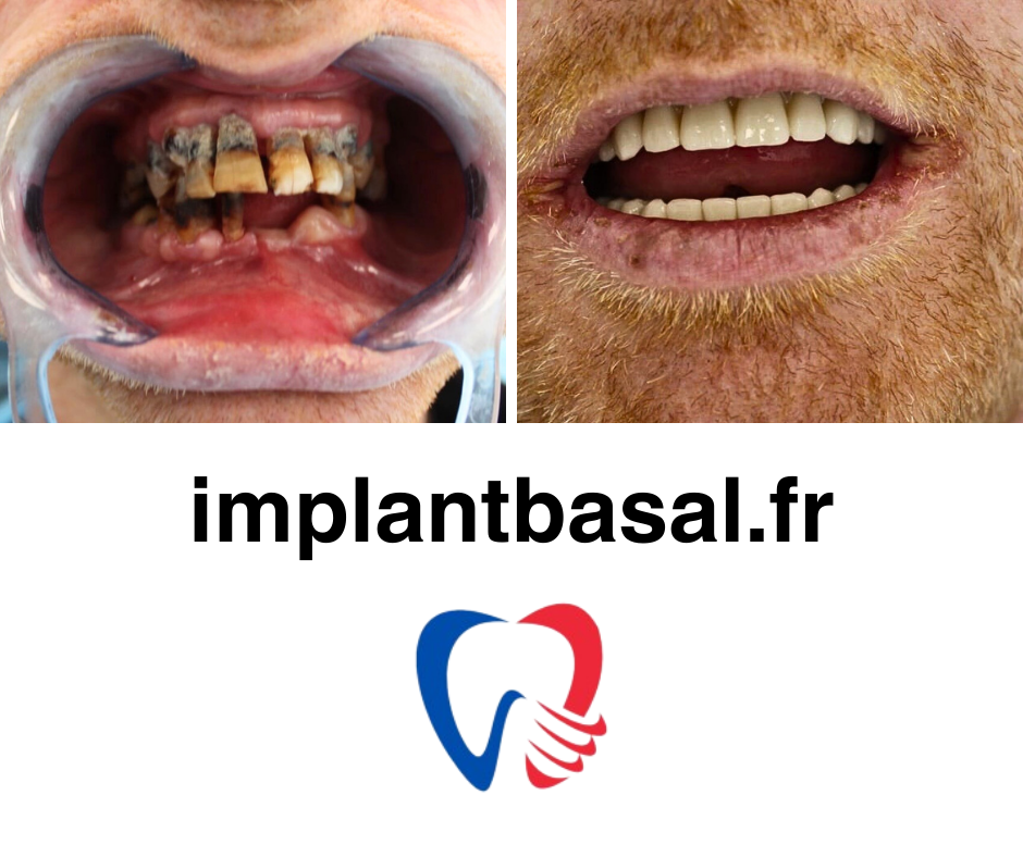 implant basal photo 12