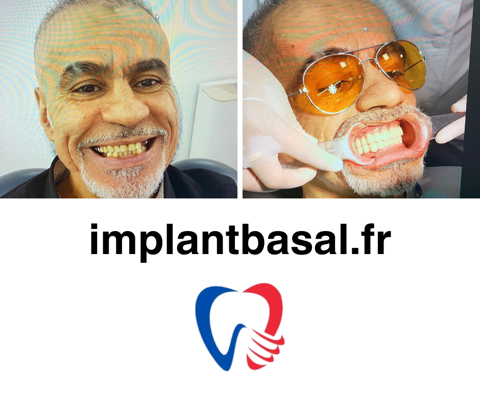 implant basal photo 14