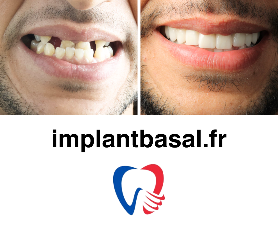 implant basal photo 15