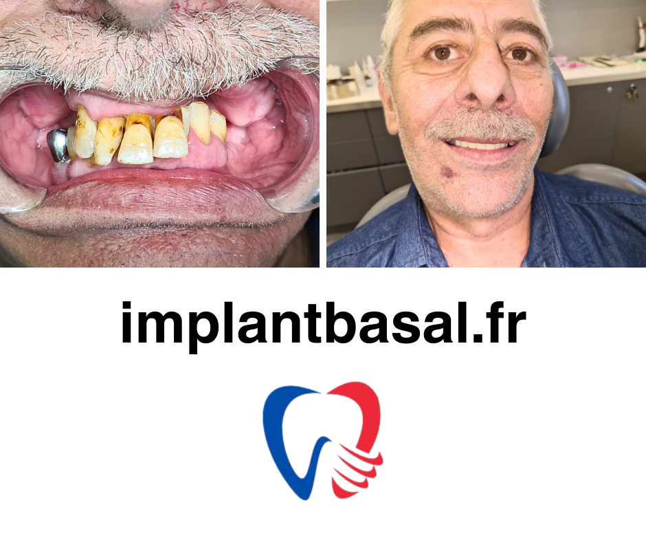 implant basal photo 4