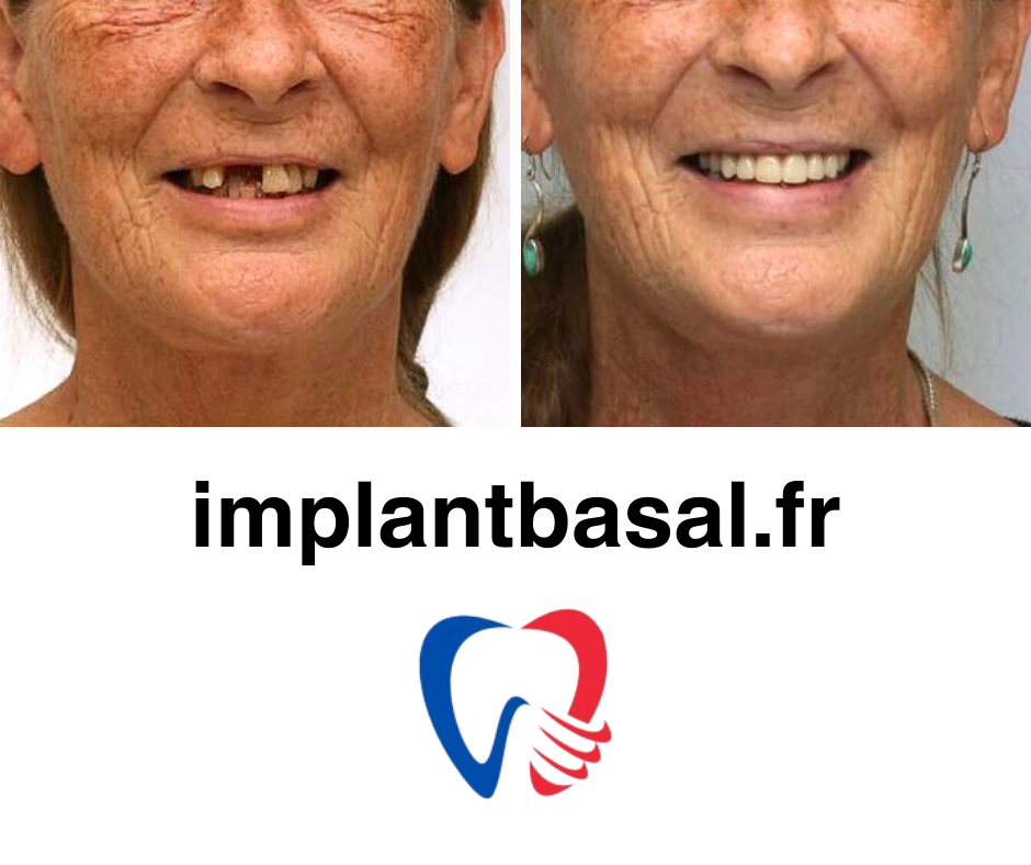 implant basal photo 5