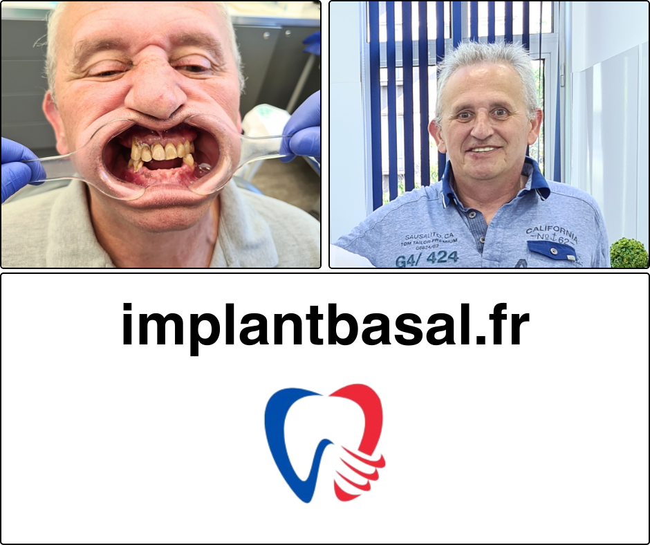 implant basal photo 6