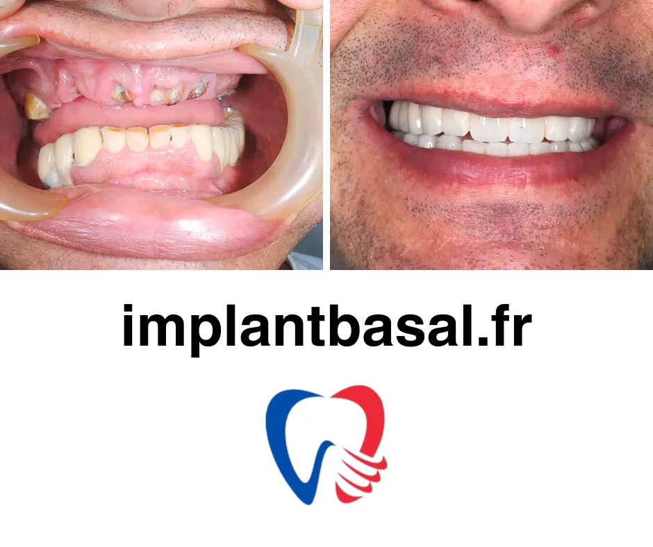Implant basal prix
