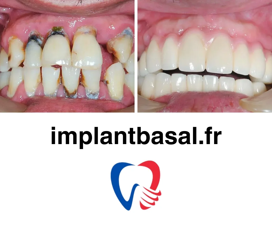 Implant basal prix