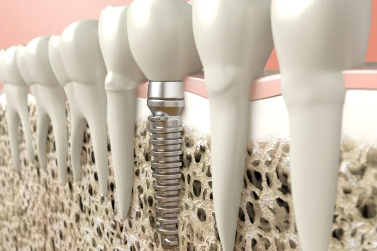 implants immédiats