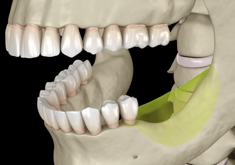 pas assez d'os pour implant dentaire