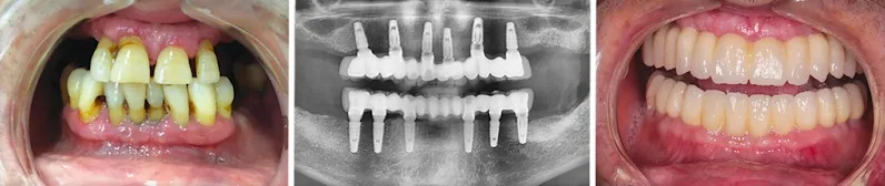prix des implants dentaires