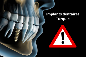 Implants dentaires Turquie