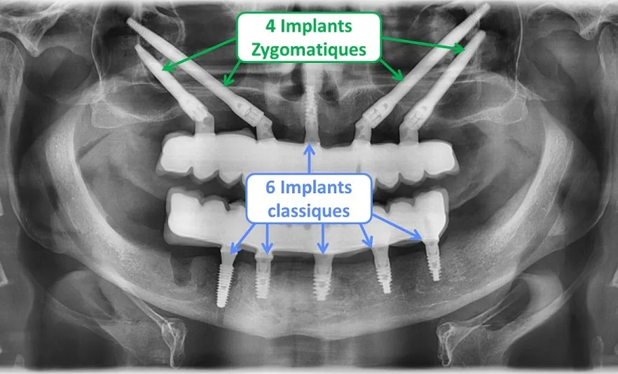 implant zygomatique