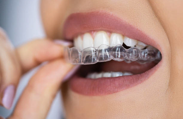 Esthétique dentaire invisalign